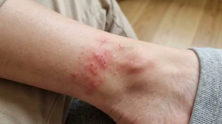 &laquo; Je pensais que la b&ecirc;te &eacute;tait encore sous ma peau &raquo; : pourquoi la larve d'ao&ucirc;tat est d&eacute;j&agrave; partie quand &ccedil;a commence &agrave; gratter