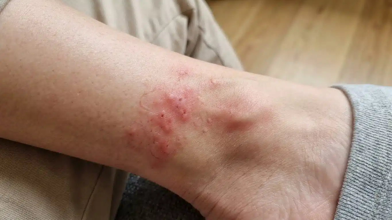 &laquo; Je pensais que la b&ecirc;te &eacute;tait encore sous ma peau &raquo; : pourquoi la larve d'ao&ucirc;tat est d&eacute;j&agrave; partie quand &ccedil;a commence &agrave; gratter
